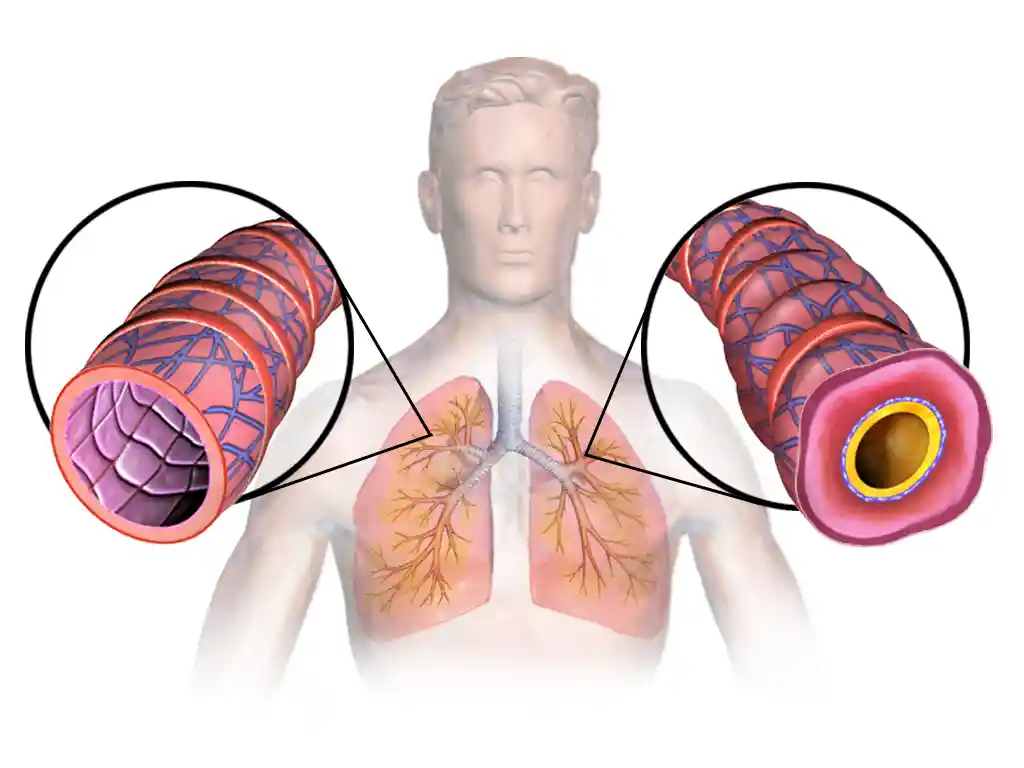 Chronic asthma